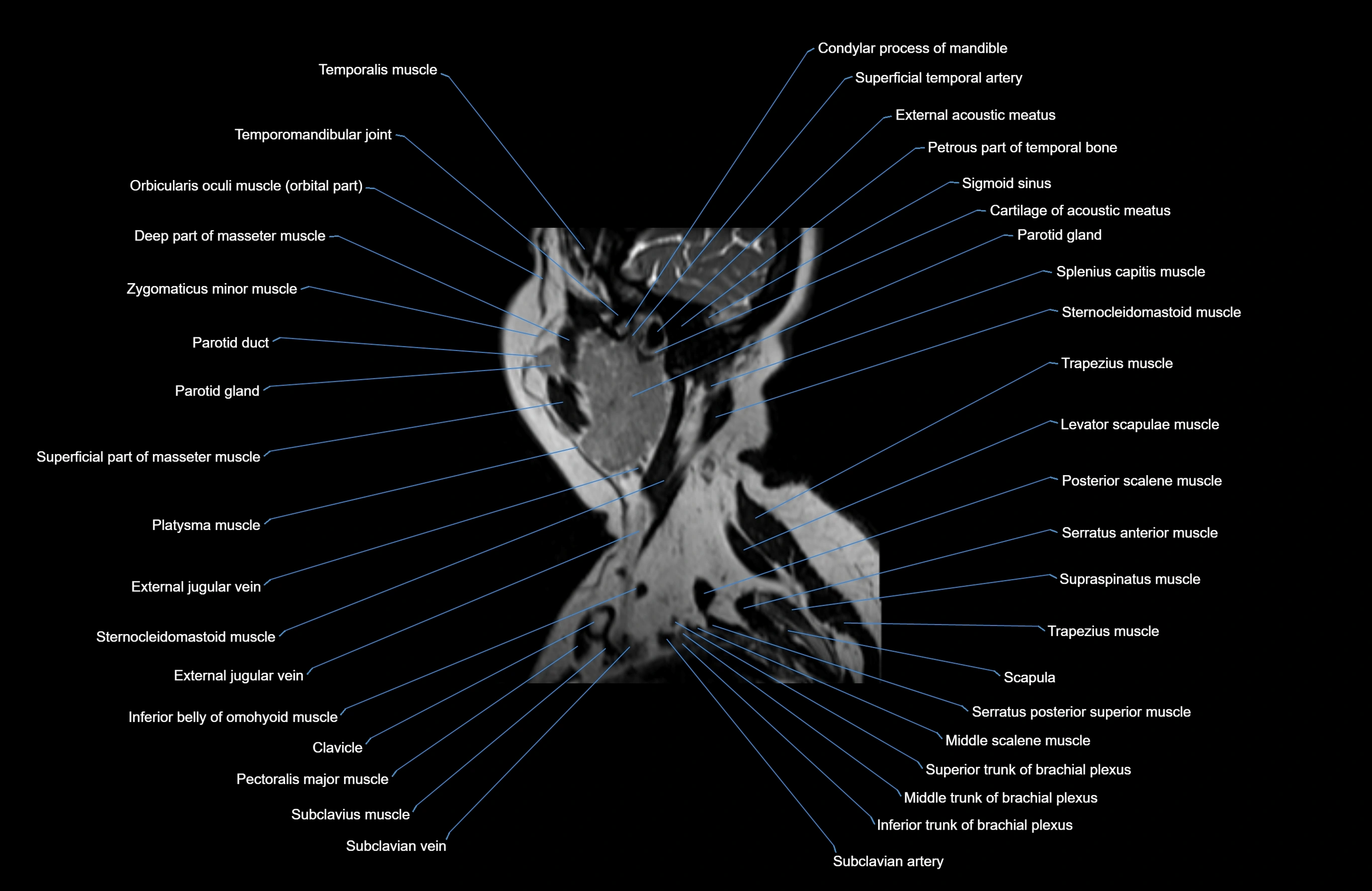 Neck MRI sagittal cross sectional anatomy 3D 1mm 3T radiology  image-img-00001-00035.webp